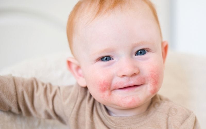 Nhiễm NO2 có triệu chứng viêm đỏ