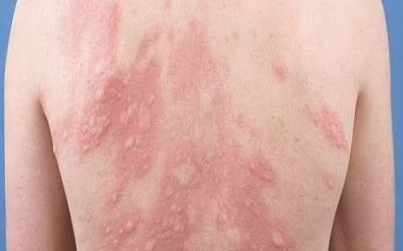 Rất nhiều trường hợp dị ứng lông động vật